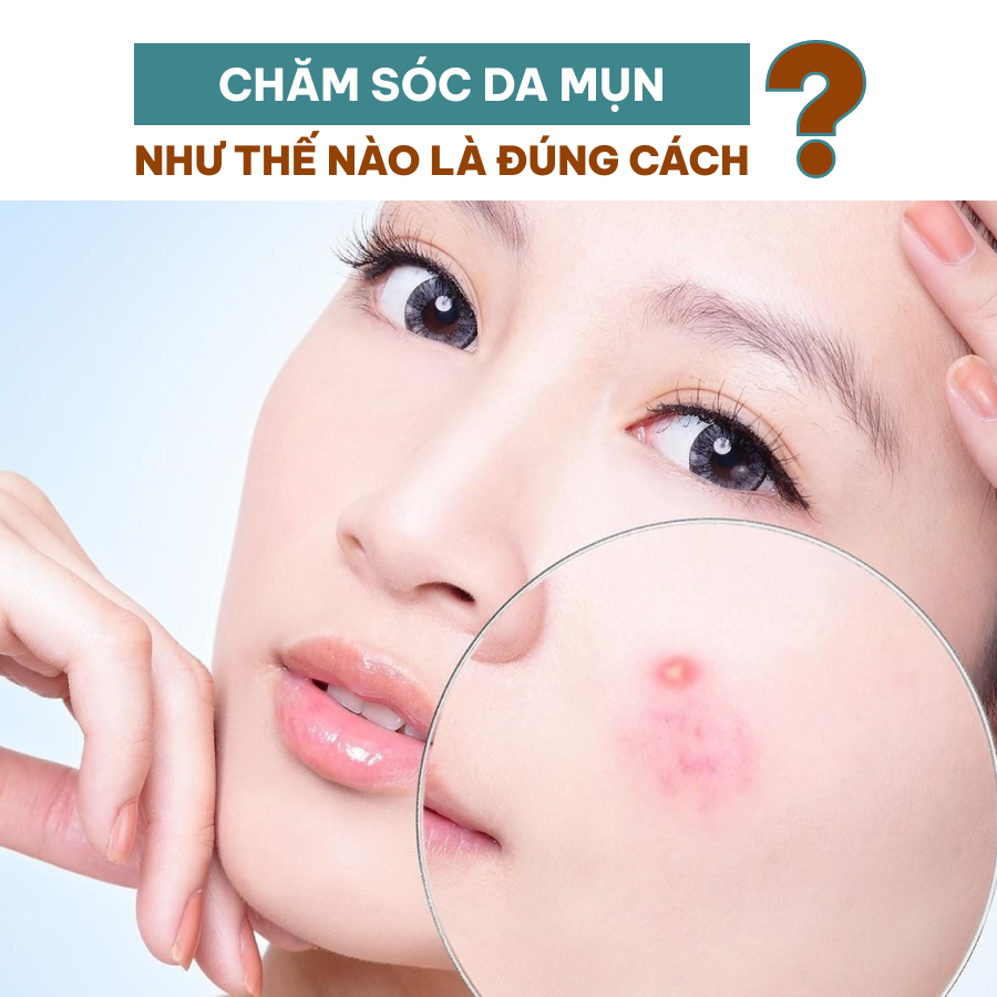 CHĂM SÓC DA MỤN NHƯ THẾ NÀO LÀ ĐÚNG CÁCH?