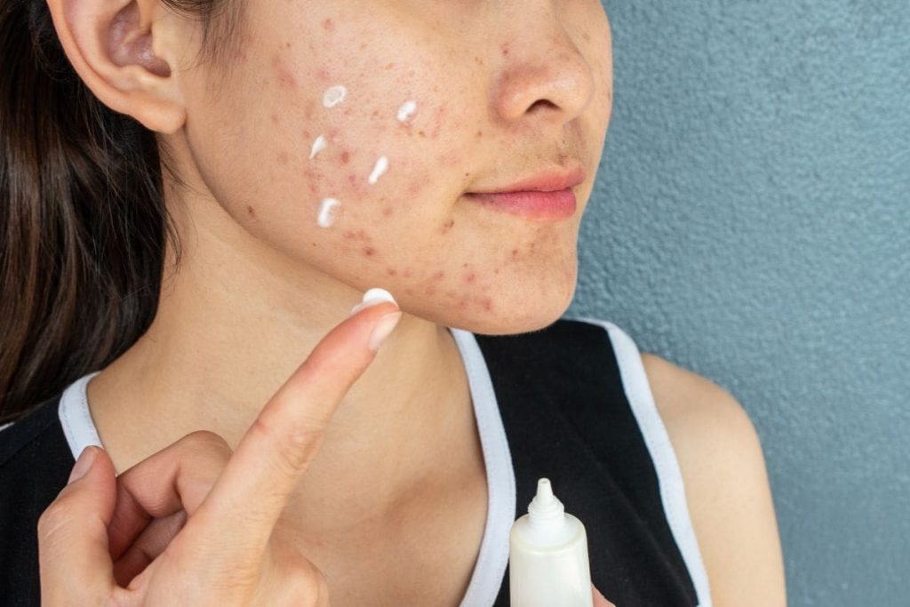 gia công kem trị mụn